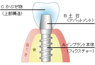 スマイル歯科のインプラント