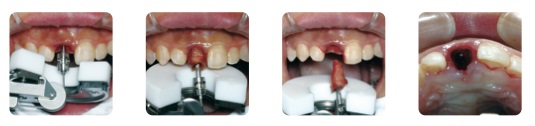 抜歯装置使用例