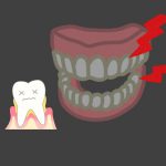 歯周病と咬み合わせの関係
